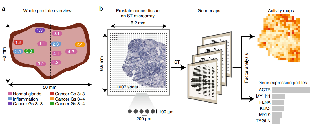 前列腺癌空间转录组分析